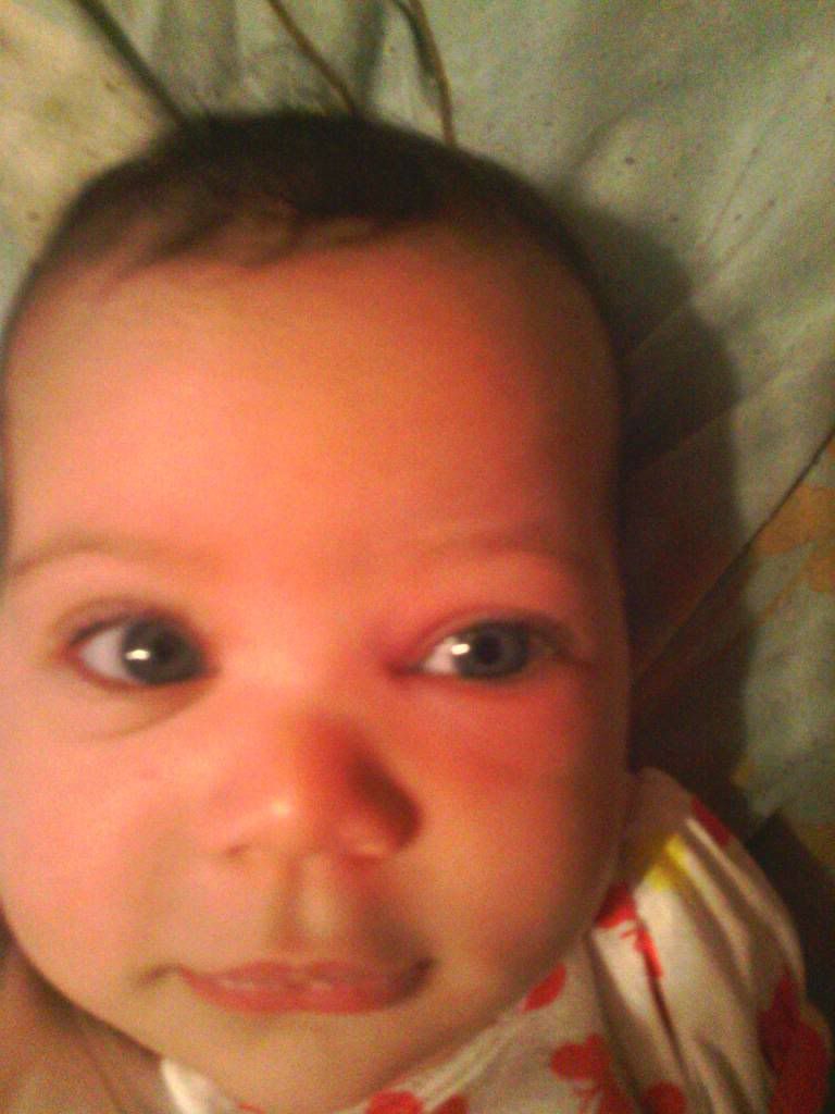 LO with swollen eye...any suggestions? *pic* BabyCenter