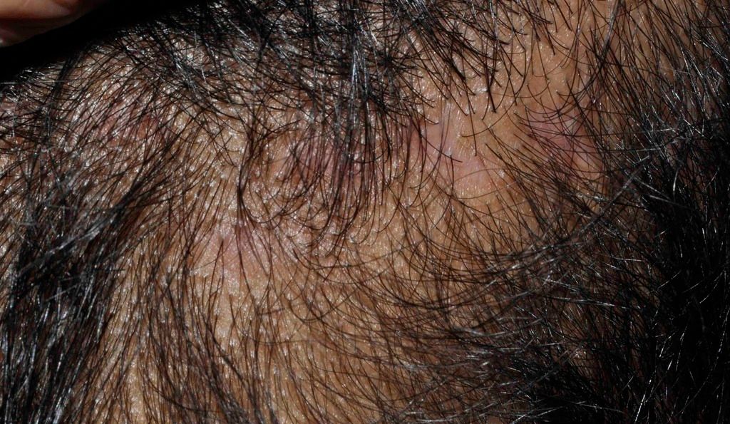 Suture%20removed%20and%20mFUE%20sites%20healing_zpsywhhsyyg.jpg
